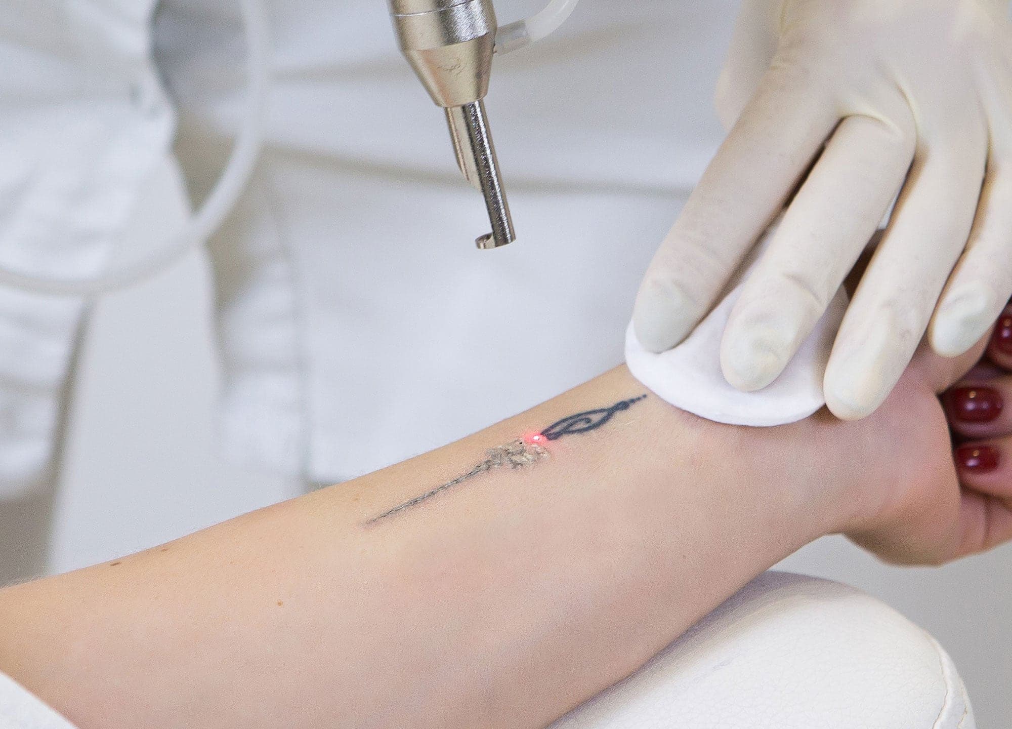 Tattoo Removal Lasers